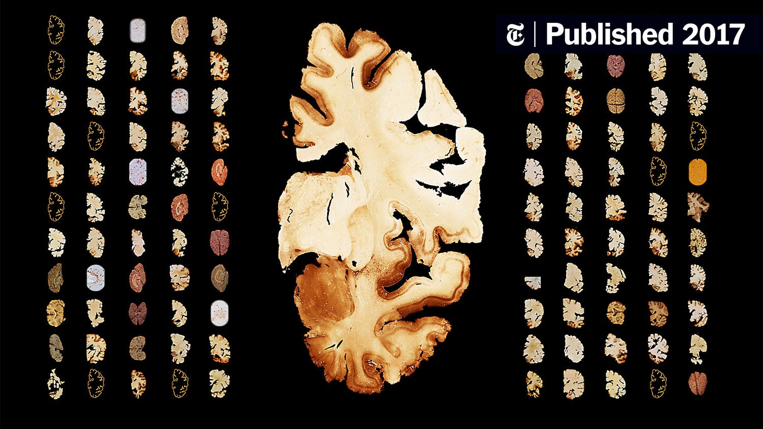 111 N.F.L. Brains. All But One Had C.T.E.