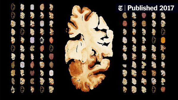 111 N.F.L. Brains. All But One Had C.T.E.